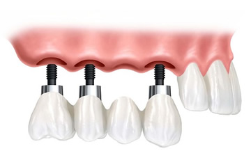 Implante e Prótese Dentária Goiânia - Implantes para perdas unitárias e parciais