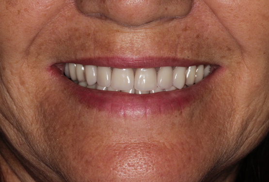 Prótese Protocolo final com dentes Premium - Heraus Kulzer Alemanha