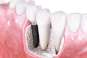 O que são implantes dentários - Implantes Goiânia